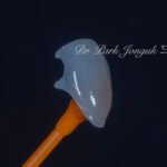 블랙 트라이앵글, Black Triangle, 블랙 트라이앵글 치료, Black Triangle Treatment, 블랙 트라이앵글 라미네이트, 교정 후 블랙 트라이앵글, Post-Orthodontic Black Triangle, 무삭제 라미네이트, No-Prep Laminate