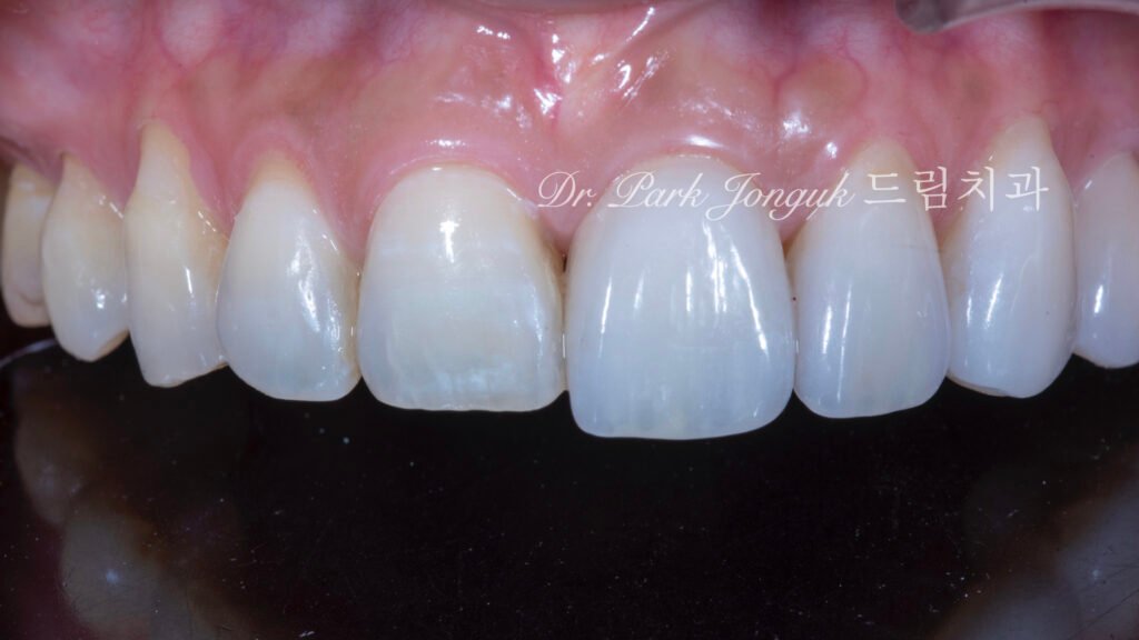 블랙 트라이앵글, Black Triangle, 블랙 트라이앵글 치료, Black Triangle Treatment, 블랙 트라이앵글 라미네이트, 교정 후 블랙 트라이앵글, Post-Orthodontic Black Triangle, 무삭제 라미네이트, No-Prep Laminate