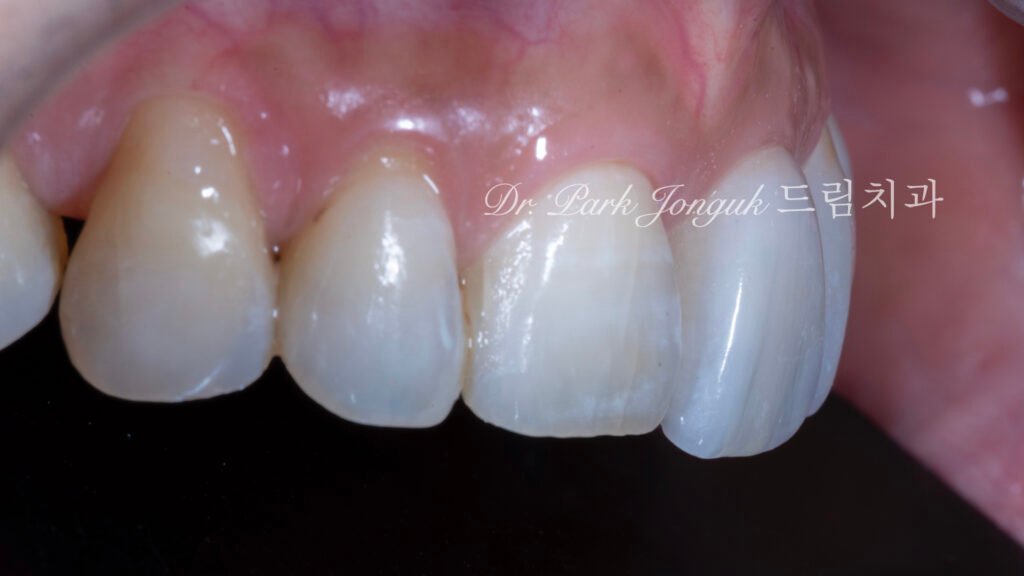 블랙 트라이앵글, Black Triangle, 블랙 트라이앵글 치료, Black Triangle Treatment, 블랙 트라이앵글 라미네이트, 교정 후 블랙 트라이앵글, Post-Orthodontic Black Triangle, 무삭제 라미네이트, No-Prep Laminate