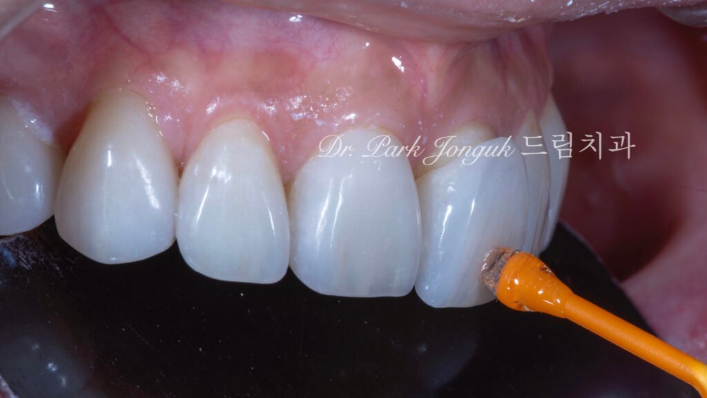 블랙 트라이앵글, Black Triangle, 블랙 트라이앵글 치료, Black Triangle Treatment, 블랙 트라이앵글 라미네이트, 교정 후 블랙 트라이앵글, Post-Orthodontic Black Triangle, 무삭제 라미네이트, No-Prep Laminate