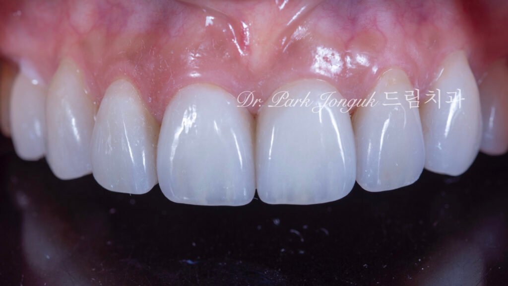 블랙 트라이앵글, Black Triangle, 블랙 트라이앵글 치료, Black Triangle Treatment, 블랙 트라이앵글 라미네이트, 교정 후 블랙 트라이앵글, Post-Orthodontic Black Triangle, 무삭제 라미네이트, No-Prep Laminate