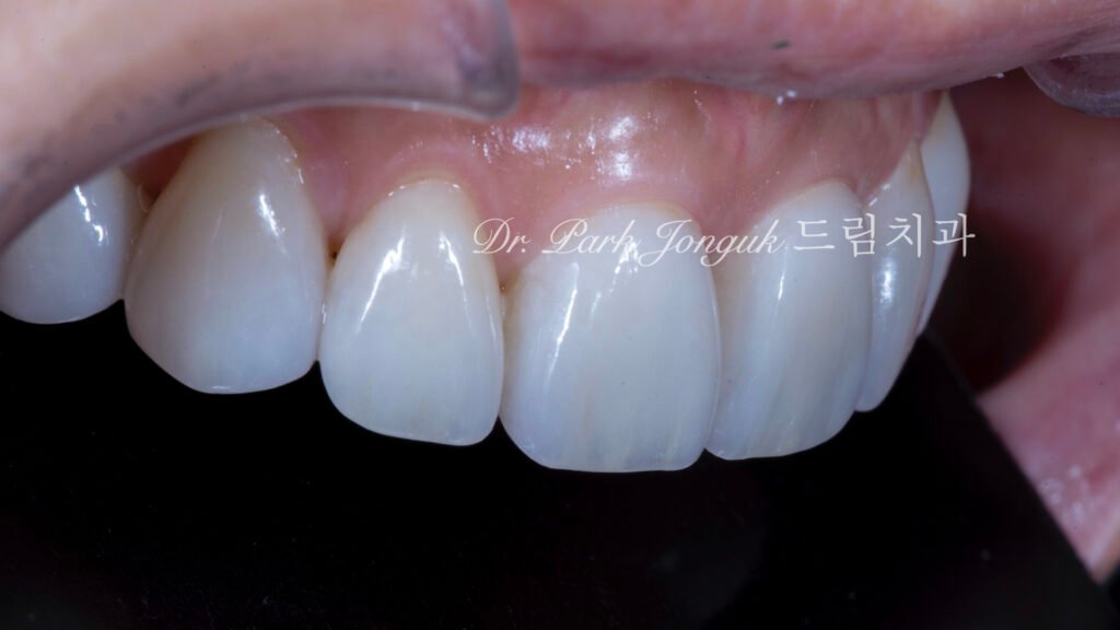 블랙 트라이앵글, Black Triangle, 블랙 트라이앵글 치료, Black Triangle Treatment, 블랙 트라이앵글 라미네이트, 교정 후 블랙 트라이앵글, Post-Orthodontic Black Triangle, 무삭제 라미네이트, No-Prep Laminate