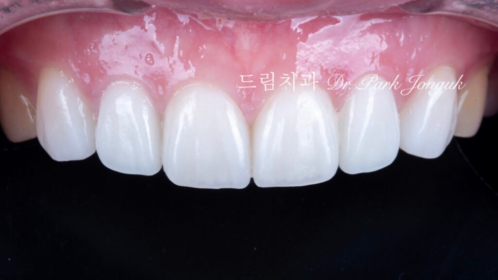 자연스러운 라미네이트