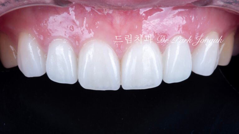 자연스러운 라미네이트