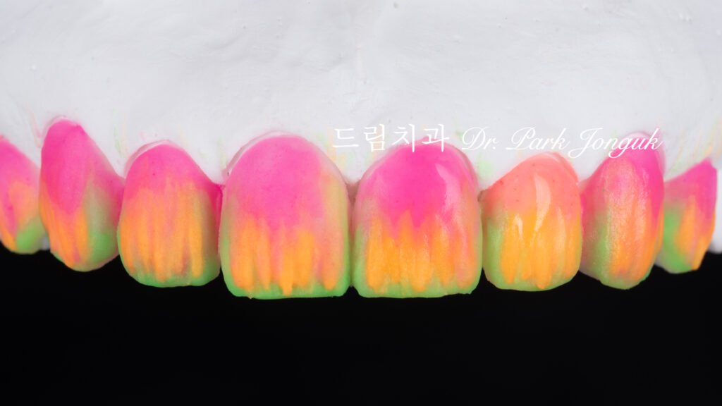 투명한 라미네이트, Translucent Laminate, 라미네이트 빌드업, Laminate Build-up, 원데이 라미네이트, One-day Laminate, 라미네이트 제작 방식, Fabrication Method, 자연스러운 라미네이트, Natural Laminate