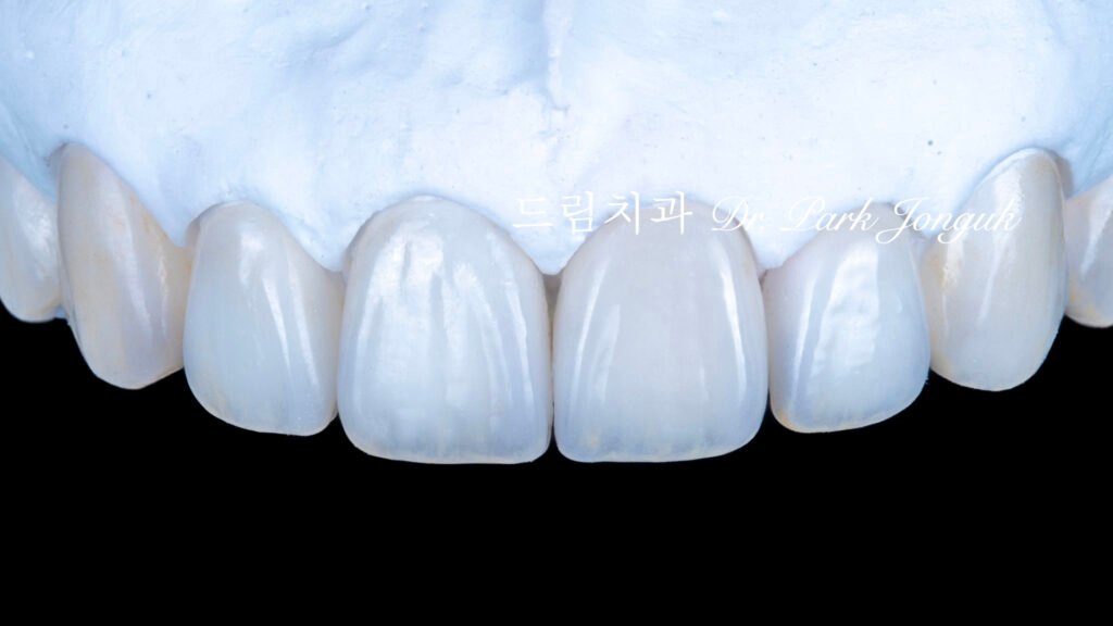 투명한 라미네이트, Translucent Laminate, 라미네이트 빌드업, Laminate Build-up, 원데이 라미네이트, One-day Laminate, 라미네이트 제작 방식, Fabrication Method, 자연스러운 라미네이트, Natural Laminate