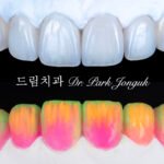 라미네이트 가격, Laminate Veneer Cost, 라미네이트 비용, Laminate Price, 라미네이트 가격 차이, 빌드업 라미네이트, Build-up Laminate, 원데이 라미네이트, One-day Laminate, 라미네이트 잘하는 곳