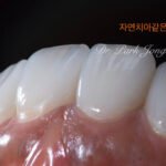 자연스러운 라미네이트