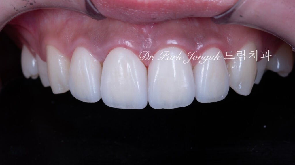 라미네이트 세팅 직후