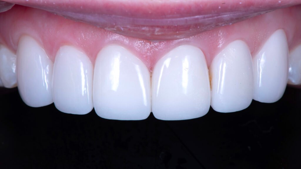 초진 시 기존 보철물 상태 — 불투명하고 어색한 라미네이트