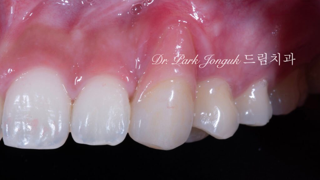 앞니 라미네이트, Anterior Laminate Veneer, 잇몸 라미네이트, Gingival Reproduction Laminate, 잇몸이 내려간 앞니, Gingival Recession, 핑크 세라믹, Pink Ceramic, 잇몸 퇴축, Recession Treatment