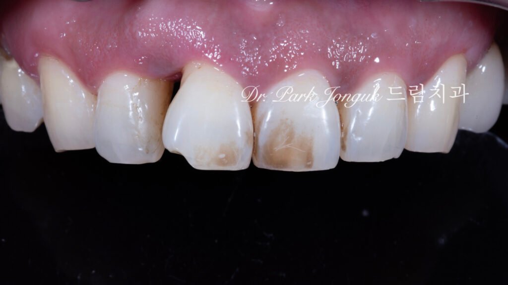 앞니 라미네이트, Anterior Laminate Veneer, 잇몸 라미네이트, Gingival Reproduction Laminate, 잇몸이 내려간 앞니, Gingival Recession, 핑크 세라믹, Pink Ceramic, 잇몸 퇴축, Recession Treatment