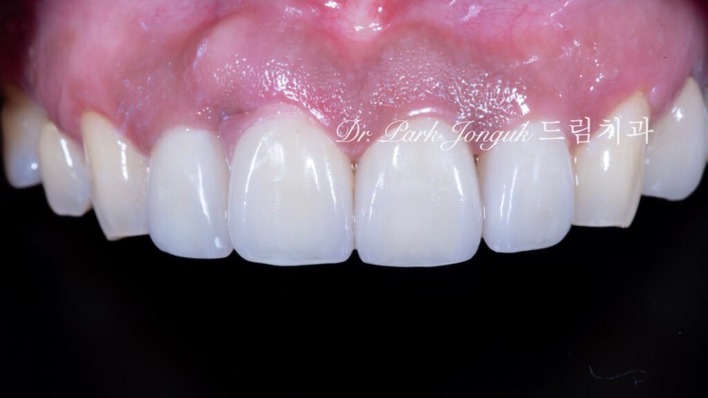 앞니 라미네이트, Anterior Laminate Veneer, 잇몸 라미네이트, Gingival Reproduction Laminate, 잇몸이 내려간 앞니, Gingival Recession, 핑크 세라믹, Pink Ceramic, 잇몸 퇴축, Recession Treatment