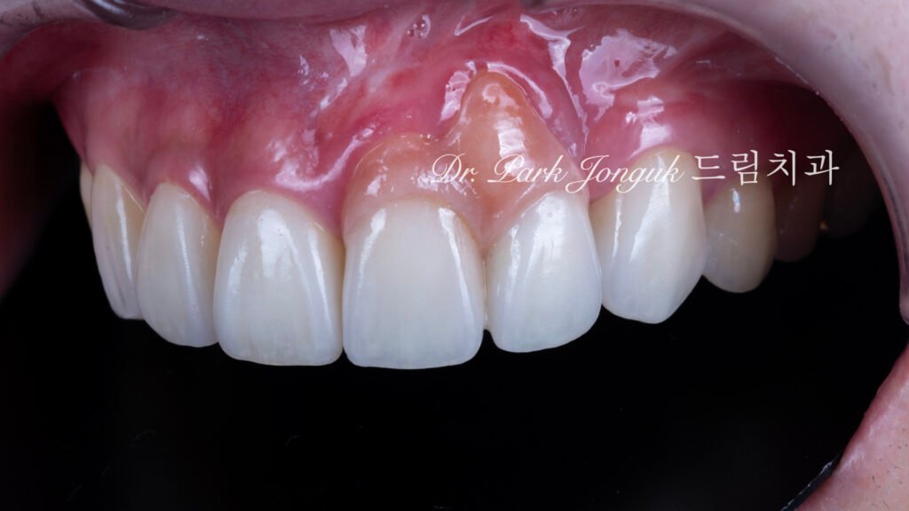 앞니 라미네이트, Anterior Laminate Veneer, 잇몸 라미네이트, Gingival Reproduction Laminate, 잇몸이 내려간 앞니, Gingival Recession, 핑크 세라믹, Pink Ceramic, 잇몸 퇴축, Recession Treatment