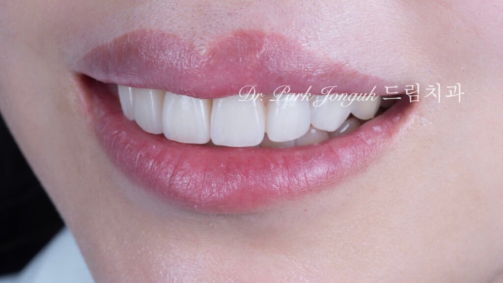 앞니 라미네이트, Anterior Laminate Veneer, 잇몸 라미네이트, Gingival Reproduction Laminate, 잇몸이 내려간 앞니, Gingival Recession, 핑크 세라믹, Pink Ceramic, 잇몸 퇴축, Recession Treatment