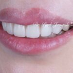 앞니 라미네이트, Anterior Laminate Veneer, 잇몸 라미네이트, Gingival Reproduction Laminate, 잇몸이 내려간 앞니, Gingival Recession, 핑크 세라믹, Pink Ceramic, 잇몸 퇴축, Recession Treatment