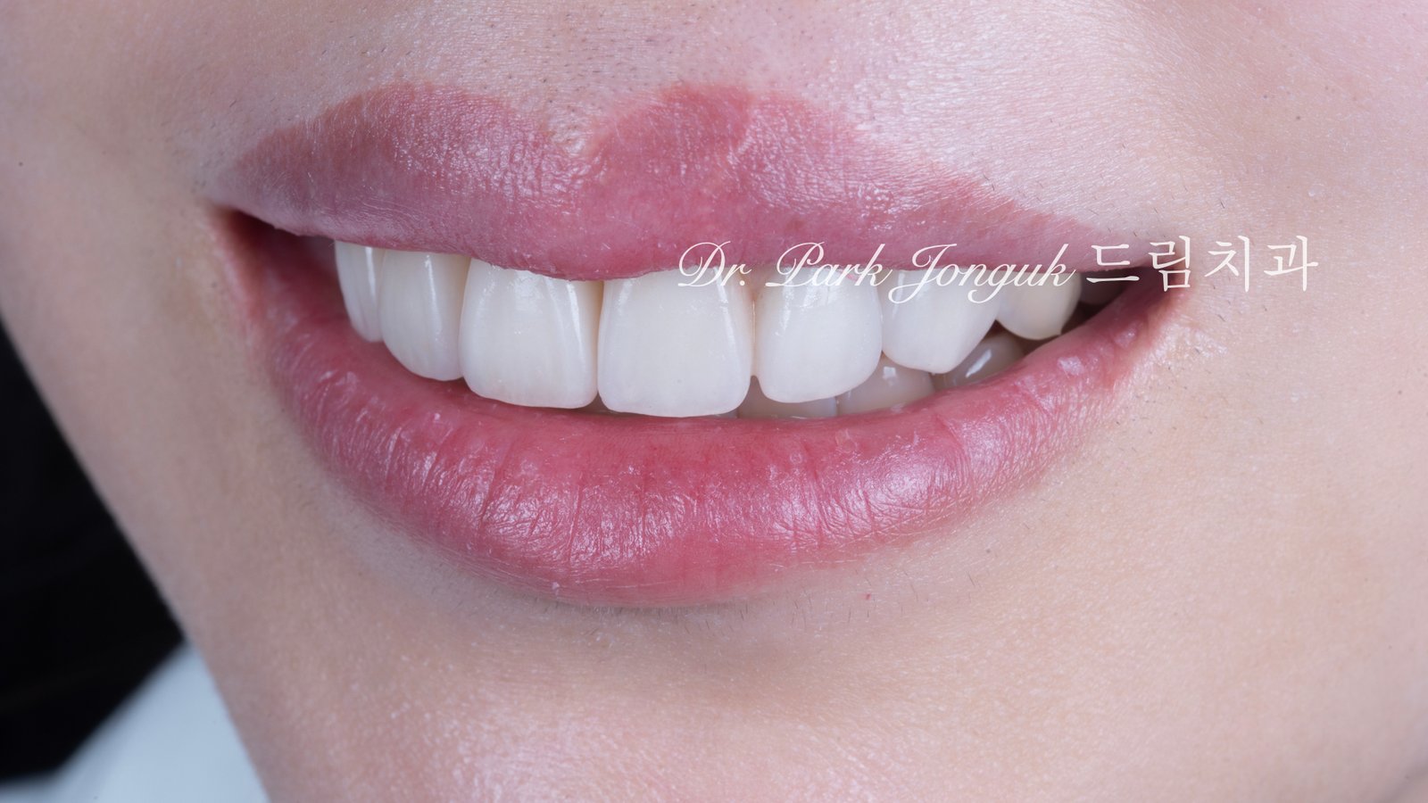 앞니 라미네이트, Anterior Laminate Veneer, 잇몸 라미네이트, Gingival Reproduction Laminate, 잇몸이 내려간 앞니, Gingival Recession, 핑크 세라믹, Pink Ceramic, 잇몸 퇴축, Recession Treatment