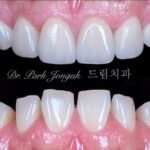 최소한의 삭제만으로 자연스러운 치아의 느낌을 살려낸 라미네이트