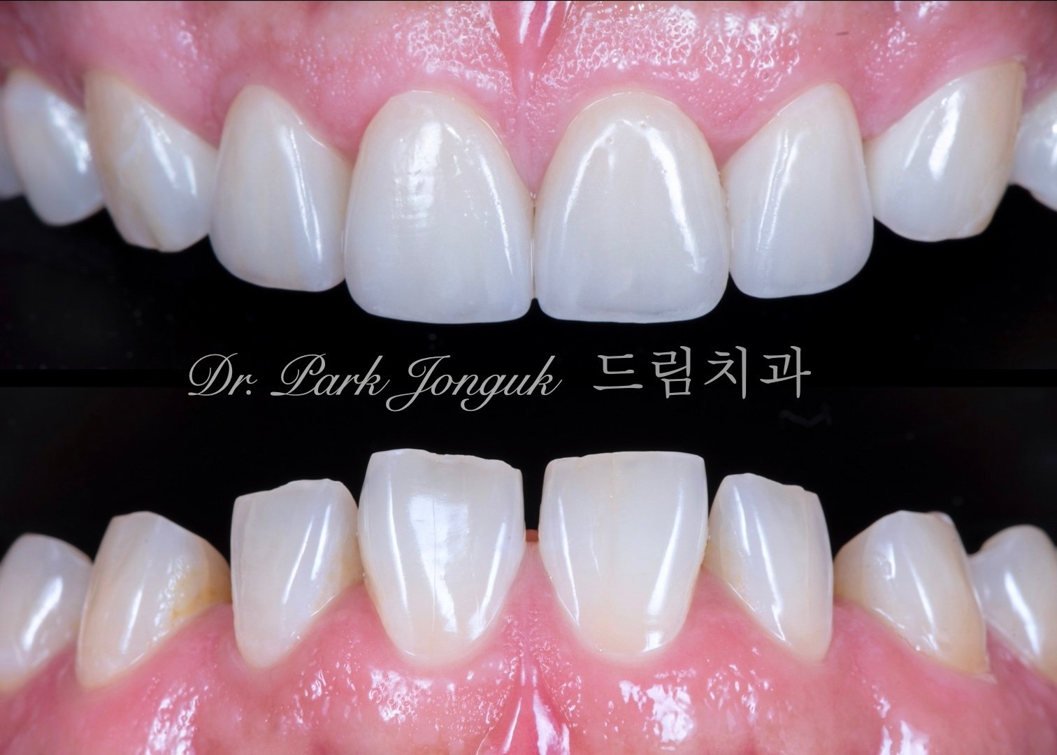 최소한의 삭제만으로 자연스러운 치아의 느낌을 살려낸 라미네이트